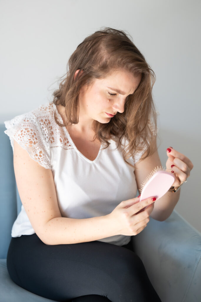 photo alopécie femme