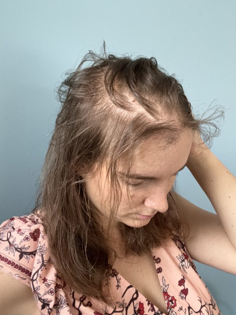 Alopécie androgénétique