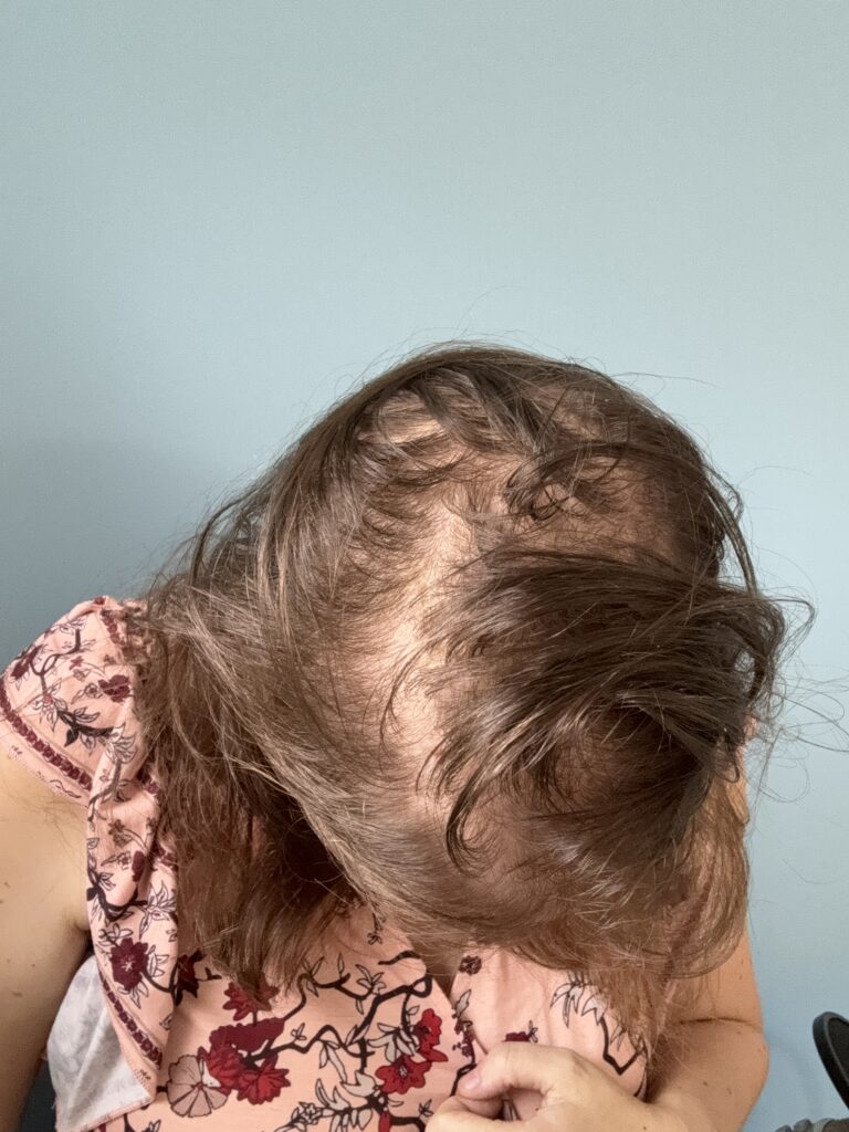 Alopécie androgénétique