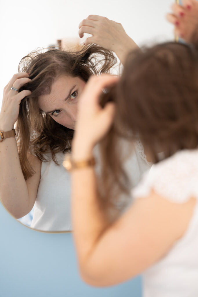 Alopécie androgénétique.  Cheveux fins et clairsemés.